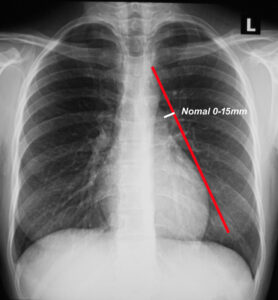 CXR PA Frontal and Cardiomegaly | Heart