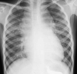 Total Anomalous Pulmonary Venous Return TAPVR | Heart