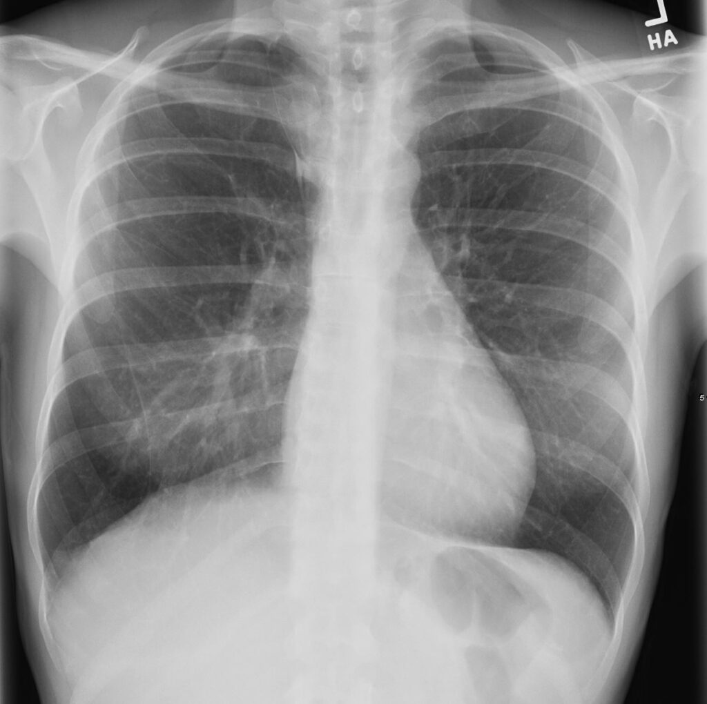 121H Small Membranous VSD | Heart