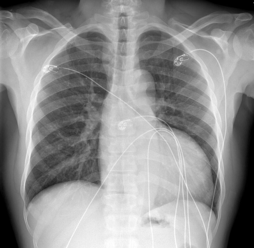 121H Cocaine Induced Hypertrophic Cardiomyopathy | Heart