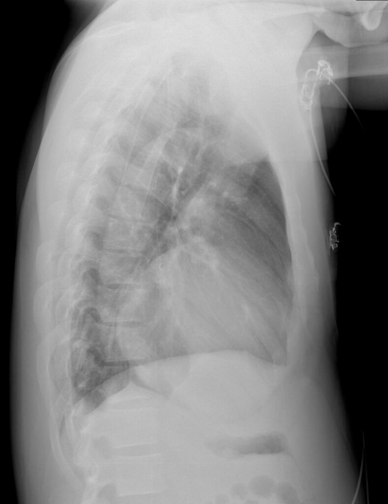 121H Cocaine Induced Hypertrophic Cardiomyopathy | Heart